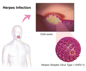 Herpes_Infection